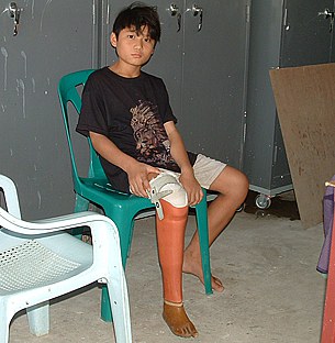 landmine_victim_305px landmine_victim_305px