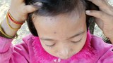 ဂန့်ဂေါမှာ ရွာသုံးရွာက ကလေး နှစ်ရာနီးပါး ရေကျောက်ရောဂါ ဖြစ်နေ