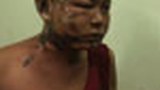 latpadaung-injured-mdy-75