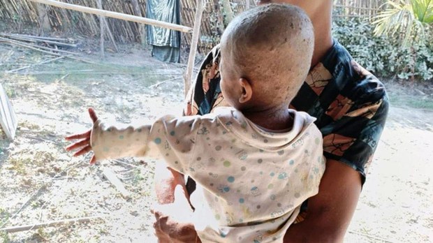 ဂွမြို့နယ်မှာ လူလေးထောင်ခန့် အရေပြားရောဂါဖြစ်နေ ဂွမြို့နယ်မှာ လူလေးထောင်ခန့် အရေပြားရောဂါဖြစ်နေ