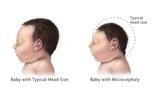 zika-baby-620.jpg