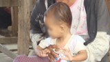 f-malnutrition
