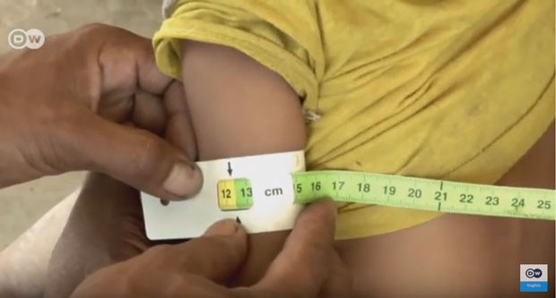 f-malnutrition