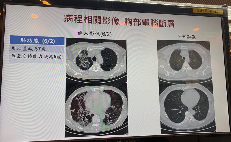 A先生胸部X光医治过程变化。(记者夏小华翻摄)